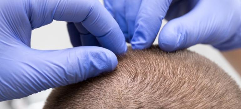 Nowa metoda regeneracji blizn z wykorzystaniem mieszków włosowych